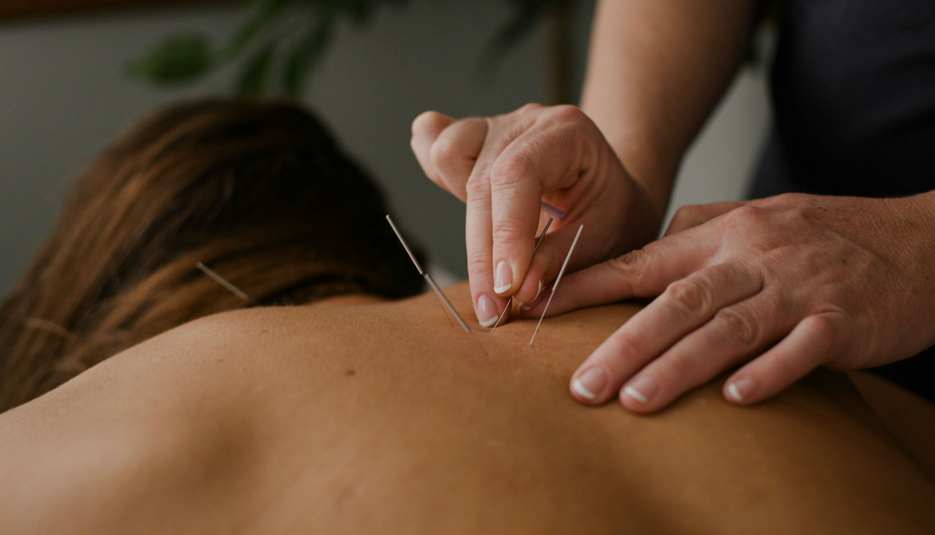 Acupuncture Different Types