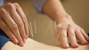 Harmony in Health Achieving Balance Through Acupuncture