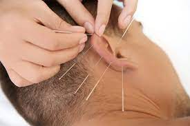 Mental Wellness Acupuncture’s Impact on Mood Disorders